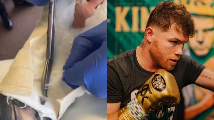 VIDEO: ¡Impactante! así quedó la mano de el "Canelo" tras la cirugía