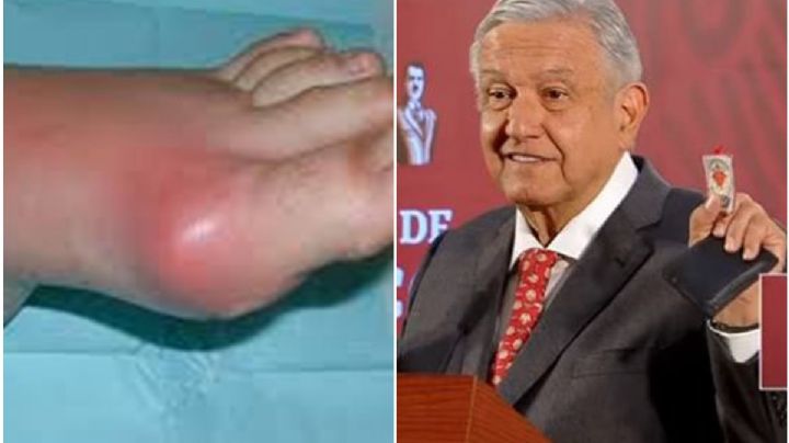 ¿Qué es la enfermedad de la gota que le diagnosticaron a AMLO?