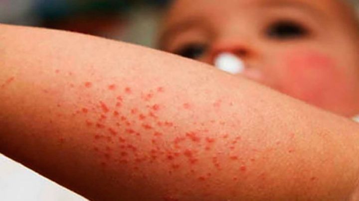 Tras contagios, especialistas descartan brote de Coxsakie en Orizaba