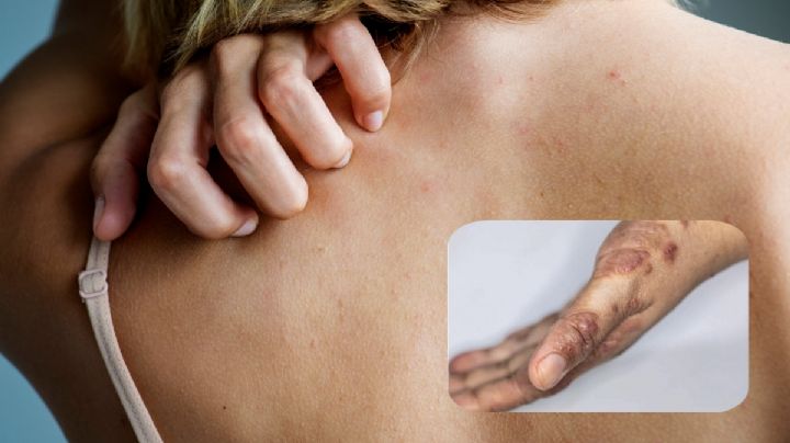 ¿Qué es la escabiosis y cómo prevenirla? Hay casos en Hidalgo