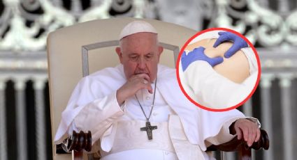 Hernia abdominal, ¿qué es el padecimiento que llevó al Papa Francisco al quirófano?