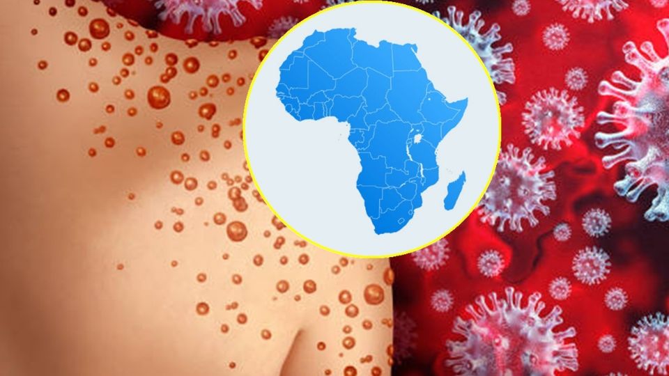 Viruela del mono: EU alerta de variante más mortal en África