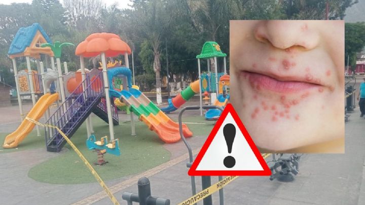 Aumentan casos de Coxsackie en Maltrata; cierran temporalmente juegos infantiles en parque principal