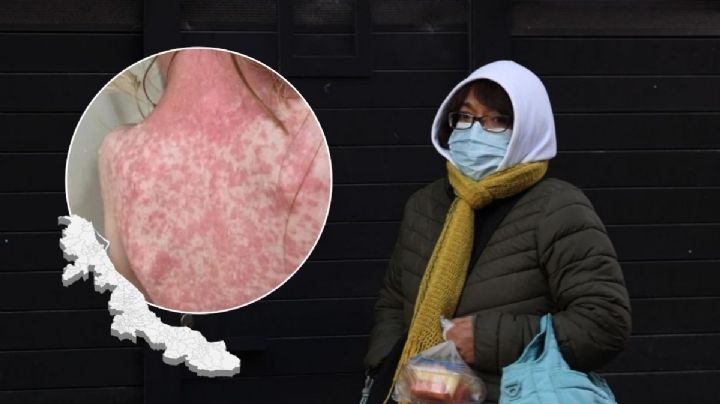 Sarampión en Veracruz suma 24 casos: Salud aclara sobre el uso obligatorio de cubrebocas con brote