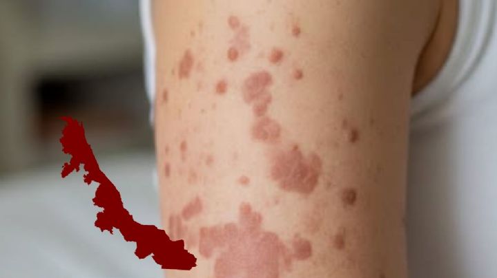 La vez que el sarampión en Veracruz dejó 26 niños muertos hace 37 años