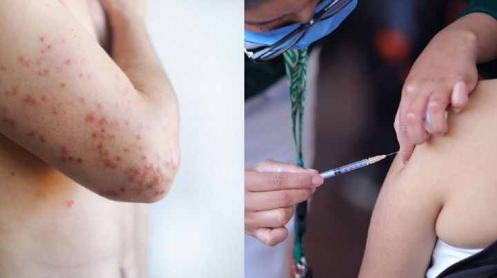 Regreso del sarampión, cuando la salud no importa