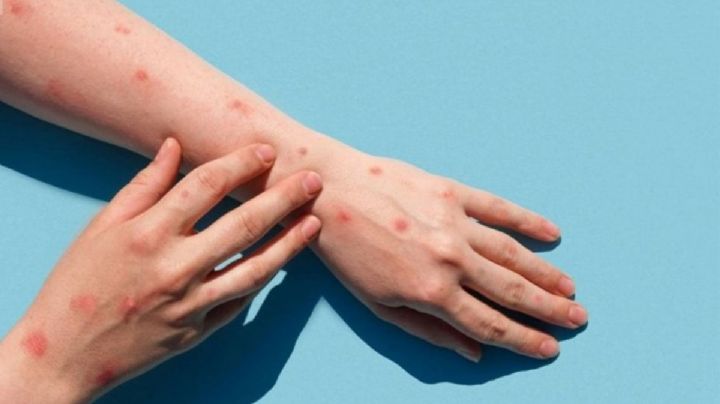 Veracruz, uno de los estados con más viruela del mono en el país