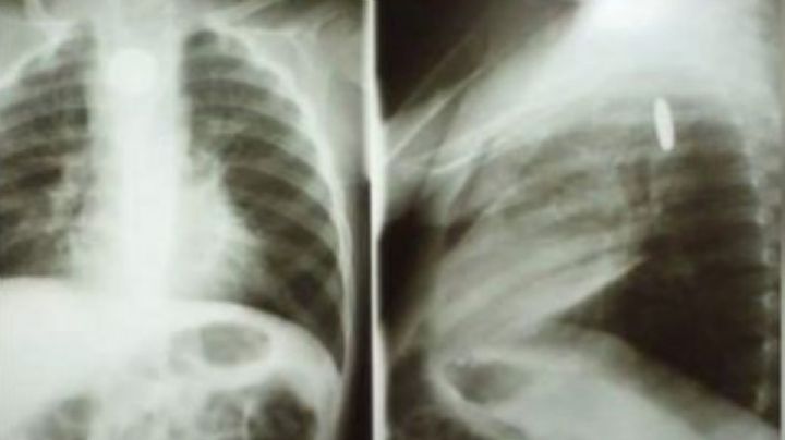 Dylan, el pequeño que lucha por su vida tras tragarse una pila