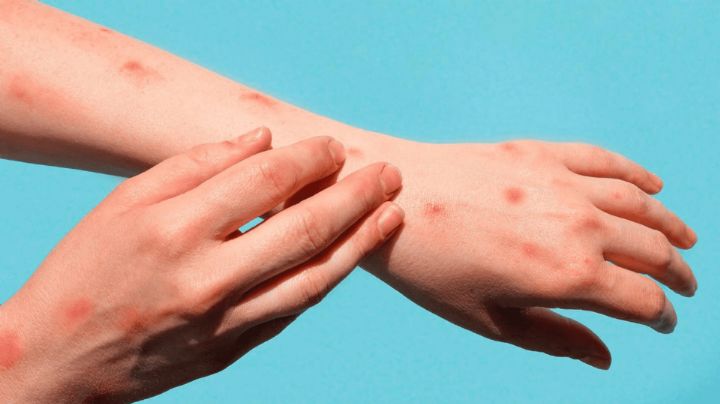 Negativo, primer caso sospechoso de viruela del mono en Hidalgo; analizan otro