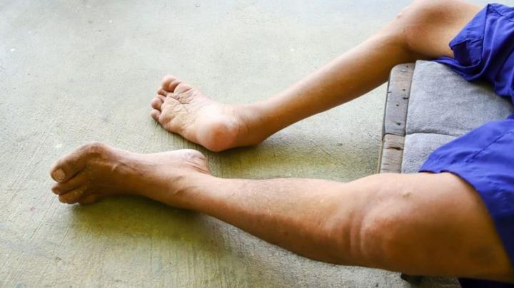 Primer caso de polio en EU en una década aparece en Nueva York