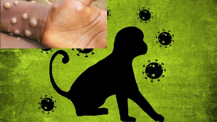 Los 12 estados con casos confirmados de viruela del mono