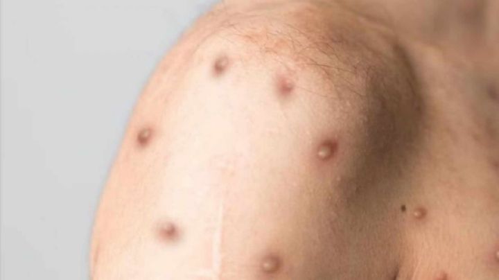 Confirman primera muerte por viruela símica en Jalisco; México suma 408 casos en 2025