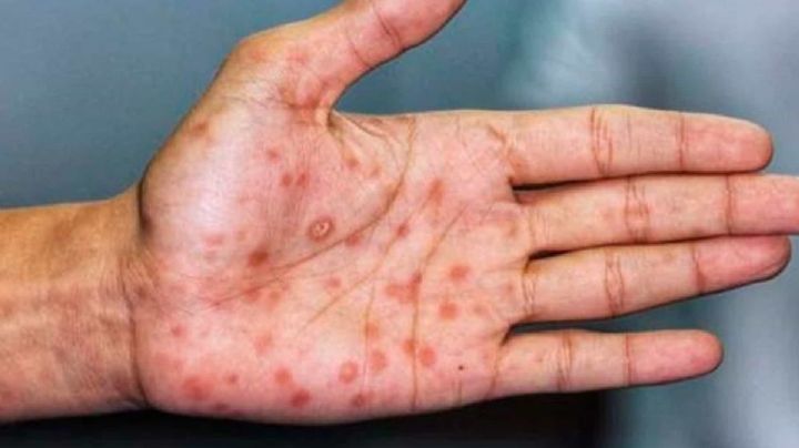 Viruela del mono: ¿Qué tanto debemos temer a esta enfermedad?