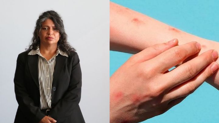 Viruela símica llegó a Hidalgo, hay dos casos confirmados y siete sospechosos