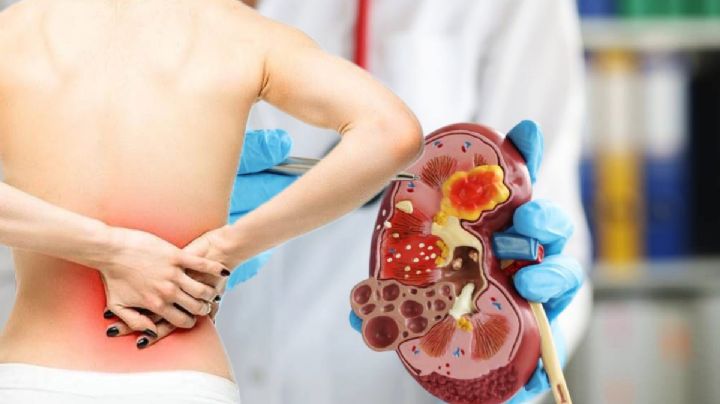 ¿Cuáles son los factores de riesgo para padecer enfermedad renal crónica?
