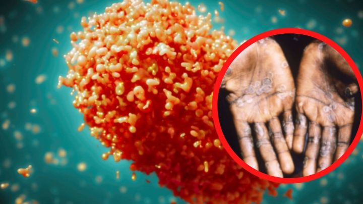 MPOX o viruela del mono alerta ante el aumento de casos en México