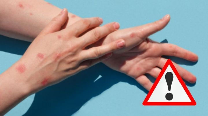 Aumentan contagios de viruela símica en Veracruz, alerta Salud