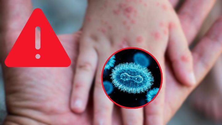 ¿Regresa la viruela símica a México? Esto sabemos