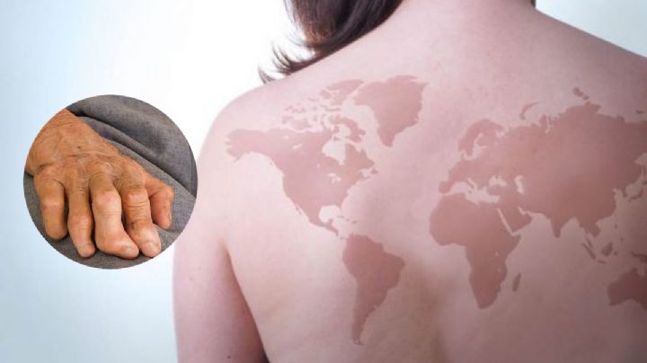 Por tercer año consecutivo, Hidalgo registra casos de lepra; estos son los síntomas