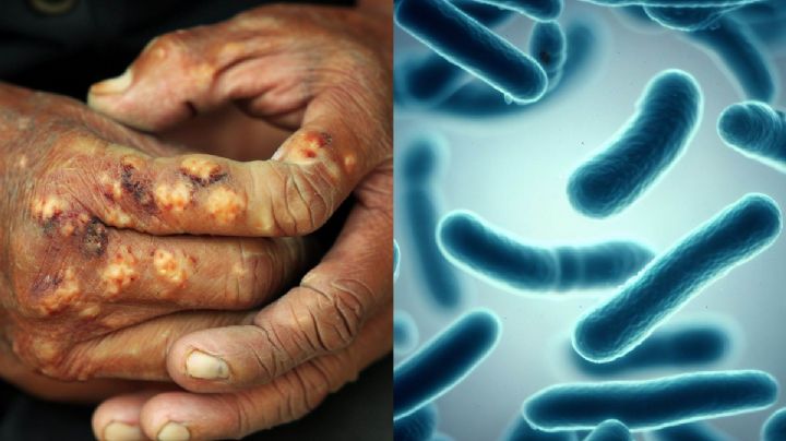 ¿Cómo se contagia la lepra? Enfermedad que ha encendido las alarmas en 12 municipios de México