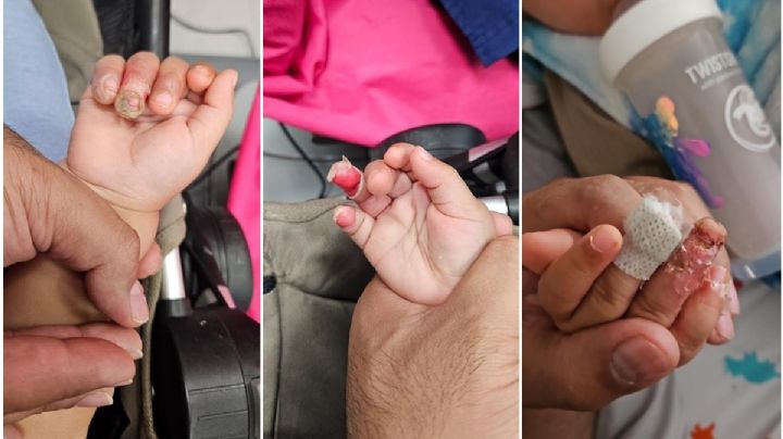 Acusan a colegio IPM Montessori por quemaduras en bebé de año y medio de edad