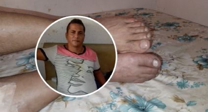 Hilario necesita 40,000 pesos para pagar cirugía y no perder su pierna