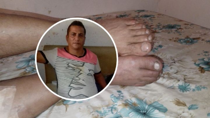 Hilario necesita 40,000 pesos para pagar cirugía y no perder su pierna
