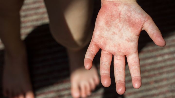 Mayoría de contagios por virus coxsackie en Hidalgo se da en escuelas; te decimos cómo prevenir