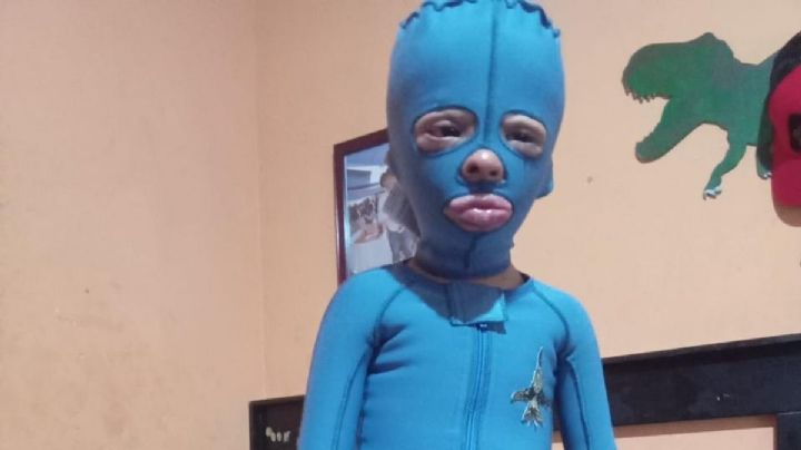 Las quemaduras no detienen a Chuchito y su papá; piden ayuda para su tratamiento