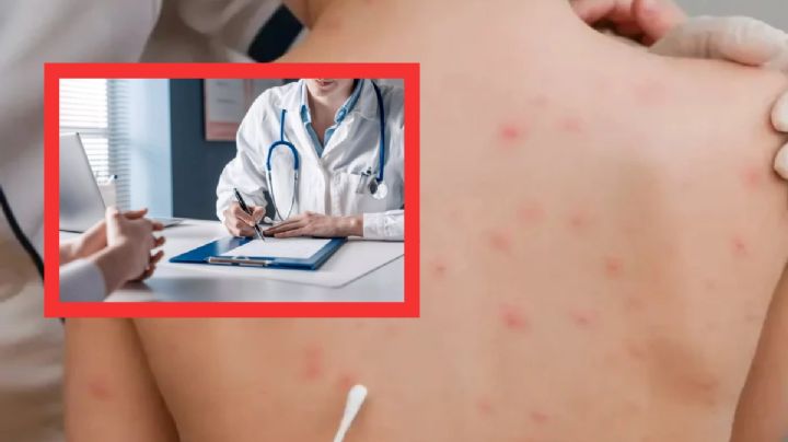 Aumentan caos de varicela en Hidalgo, así van los contagios