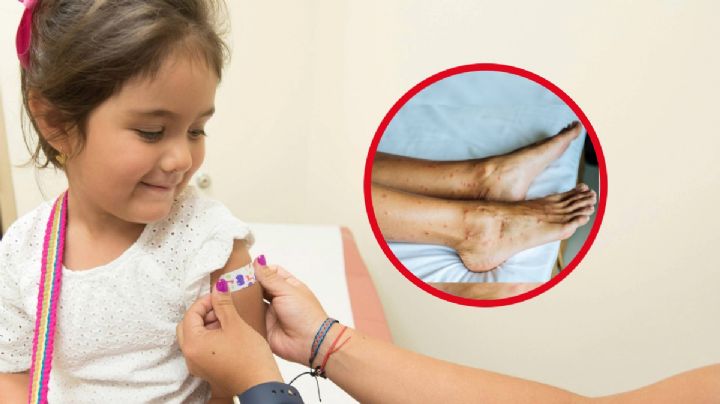 Sarampión: ¿En dónde te puedes vacunar contra el sarampión y GRATIS?