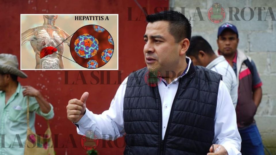Alcalde de Zozocolco confirma 16 casos de hepatitis A, ¿qué es y cómo se transmite