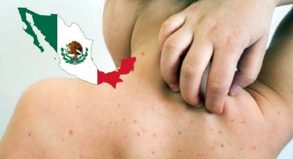 Sarampión en México: confirman 3 nuevos casos; todo lo que sabemos