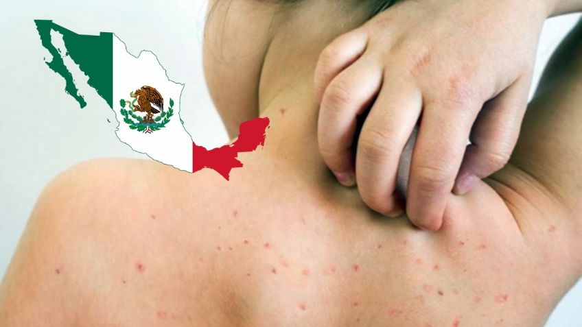 Sarampión: se registran 3 mil 779 casos en México, reporta Salud