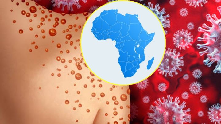 Viruela del mono: EU alerta de variante más mortal