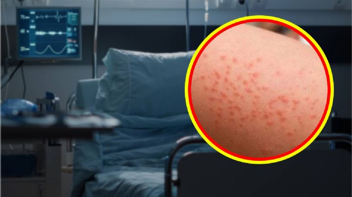 Coxsackie en Hidalgo: estos son los síntomas de la enfermedad y maneras de evitarla