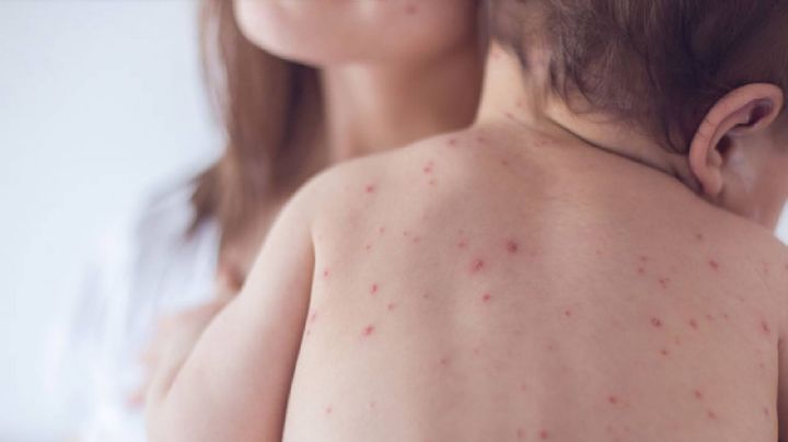 Incrementan casos de varicela en Guanajuato; ocupa el quinto lugar a nivel nacional