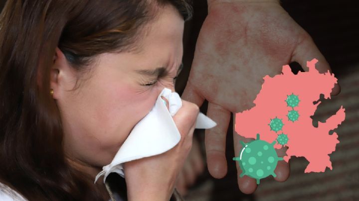 Fiebre escarlatina: Hay 24 casos en Hidalgo; te decimos qué es, síntomas y cómo prevenirla