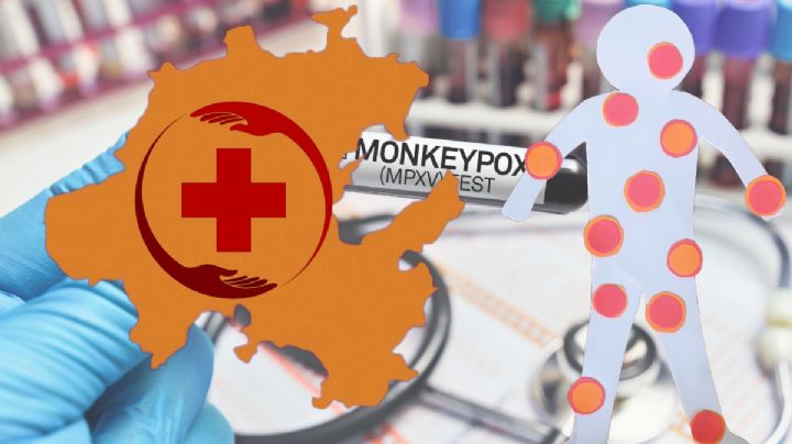 Viruela del mono: ¿cuándo apareció, sus síntomas y hay casos en Hidalgo?