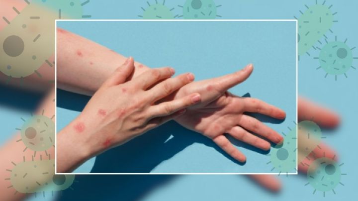 Viruela del mono en Veracruz; esto sabemos del primer caso y síntomas