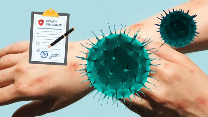 Viruela del mono: ¿cuándo fue el último caso registrado en Hidalgo?