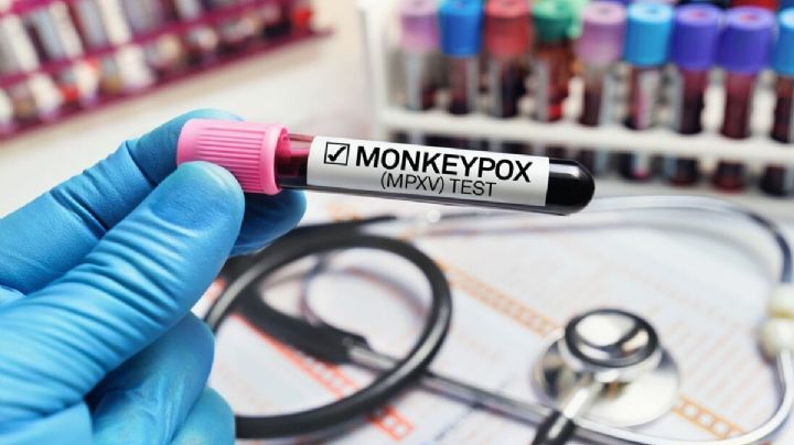 Registra Hidalgo primer caso de viruela del mono, ¿cuáles son los síntomas?