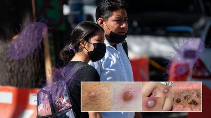 Aumentan casos de viruela del mono en Veracruz; esto dice Salud sobre vacuna