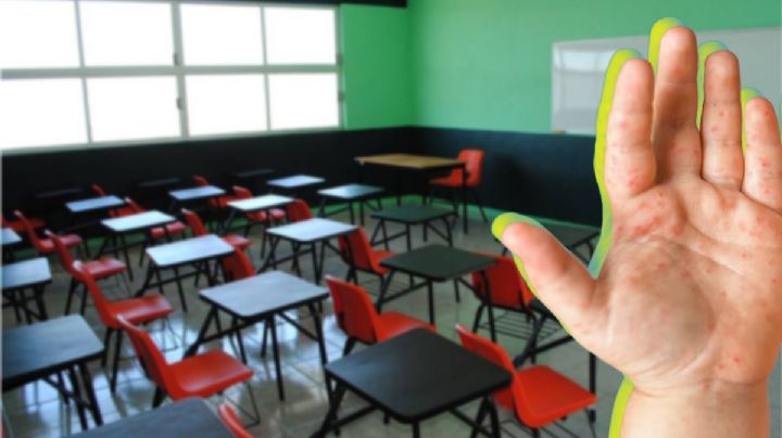 Escuelas de Pachuca reportan brotes de Coxsackie; dos casos confirmados