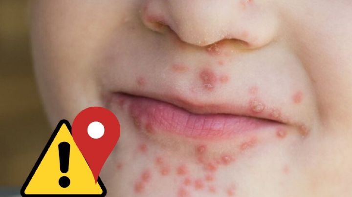 Escuelas de 3 municipios del norte de Veracruz con casos de Coxsackie