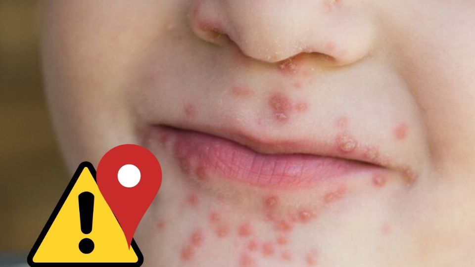 Escuelas de estos 3 municipios del norte de Veracruz reportan casos de Coxsackie