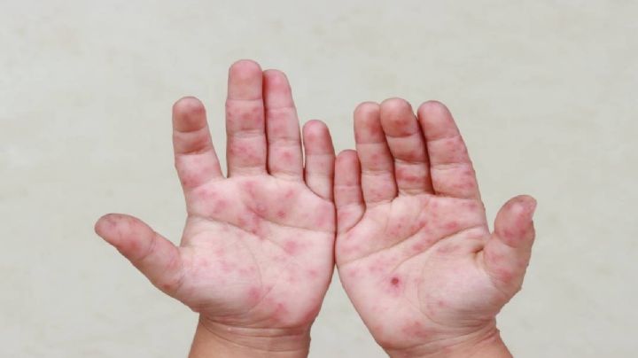 Puebla entre los estados con más casos de virus Coxsackie; ya van 201 casos