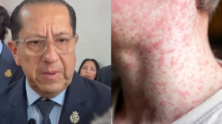 Se registra el segundo caso de Sarampión en Guanajuato, fue en Acámbaro