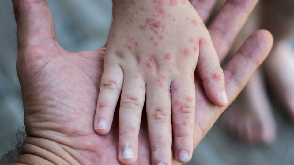 Se trata de una menor de edad sin antecedente de vacunación