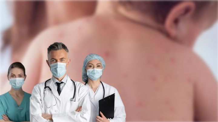 Aumentan a 43 los posibles casos de sarampión en Hidalgo; reportan 5 más en dos semanas